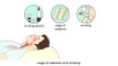 Obstructive Sleep Apnea Syndrome (OSAS) - Causes and treatment