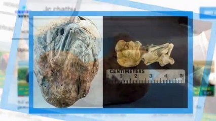 අනේ දෙවියනේ අවුරුදු 46ක් මව් කුසක් තුළ සිටි දරුවෙකු එළියට ගත් හැටි