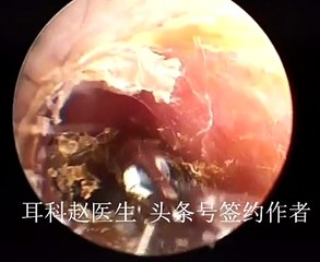 Earwax Removal, Extractions By Tweezers 这一期用钳子夹片片 外耳道耳屎清理 耳垢 耳垢