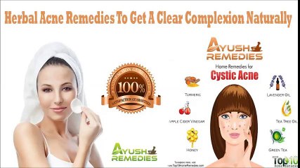 Herbal Acne Remedies To Get A Clear Complexion Naturally