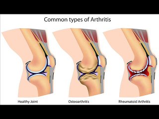 إلتهاب الغضاريف الأسباب والعلاج
