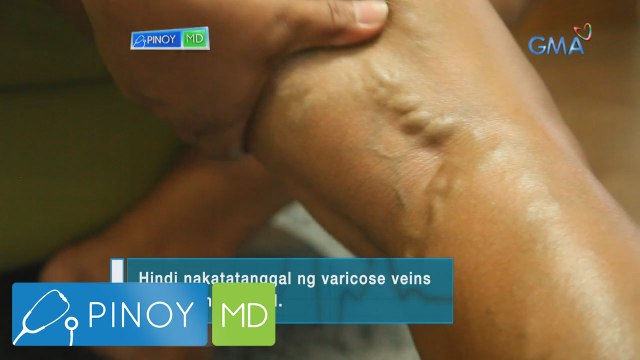 Pinoy MD: Chamomile oil, panlunas nga ba sa varicose veins?