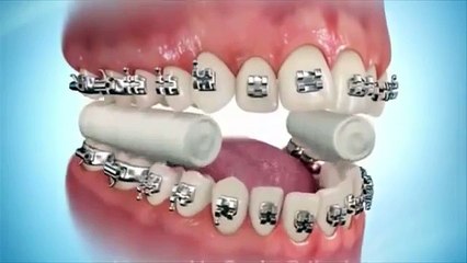 How Braces work Bangladesh Center for Orthodontics and Braces