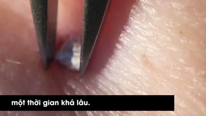 Hơn 5 triệu người đã không cưỡng nổi sức hấp dẫn của pha gắp mụn siêu hấp dẫn này
