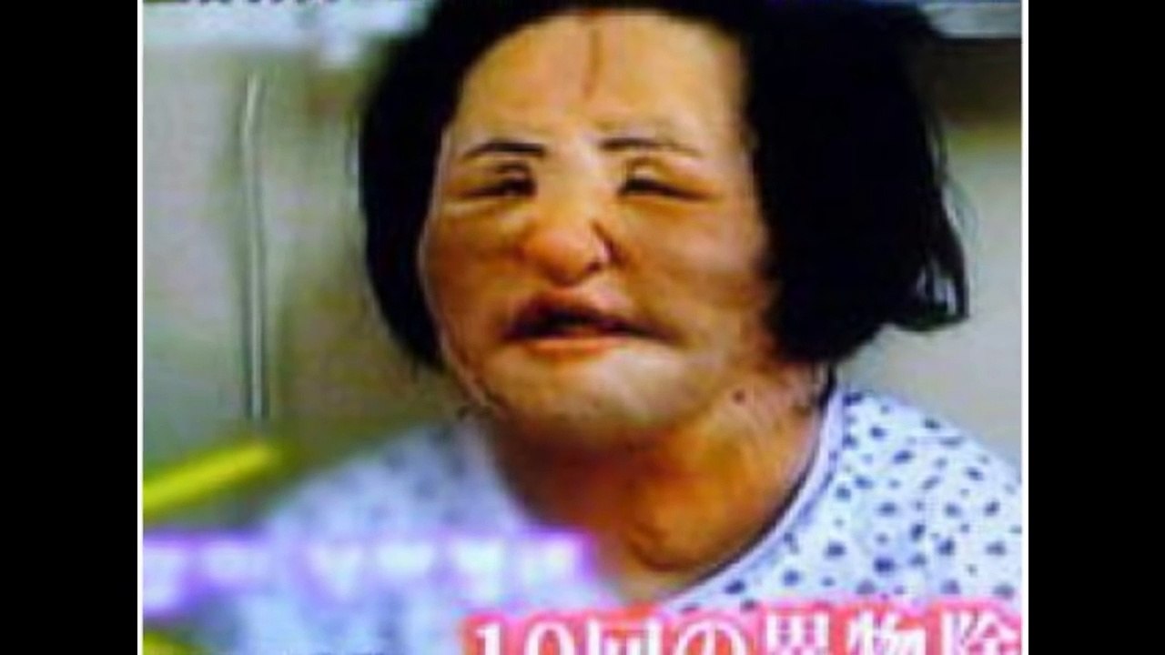 PLASTIC SURGERY GONE WRONG
