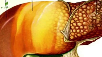 Cura Por Siempre El HÍGADO GRASO Con Un Simple Pero Muy Poderoso Ingrediente