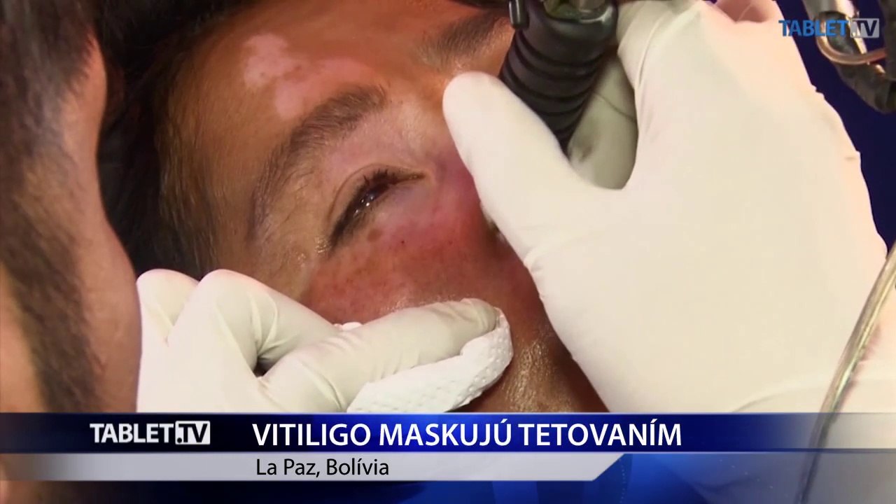 Následky choroby bielych škvŕn vitiligo odstraňujú tetovaním