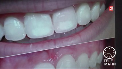 Santé - Dents : La chasse aux tâches