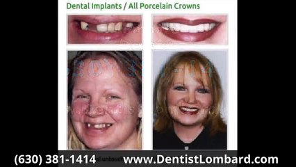 Veneers Before And After Glen Ellyn IL 630-381-1414 Glen Ellyn Before & After Dental Implants