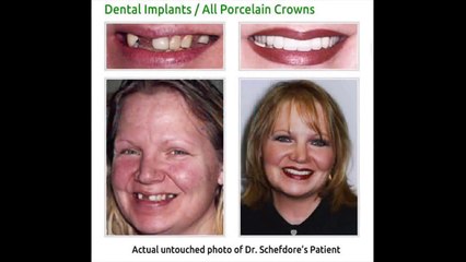 Veneers Before And After Downers Grove IL 630-381-1414 Downers Grove Before & After Dental Implants