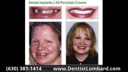 Dental Veneers Before & After Schaumburg IL 630-381-1414 Schaumburg Before & After Dental Implants