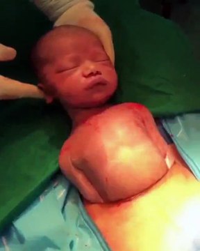 em bé tự bật ra khỏi bụng mẹ trong ca sinh mổ tự nhiên