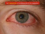 Conjuntivitis afecta a unas 1700 personas en el país