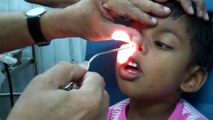 Foul Smelling Nasal Foreign Body Removal - Dr Paulose FRCS (ENT)