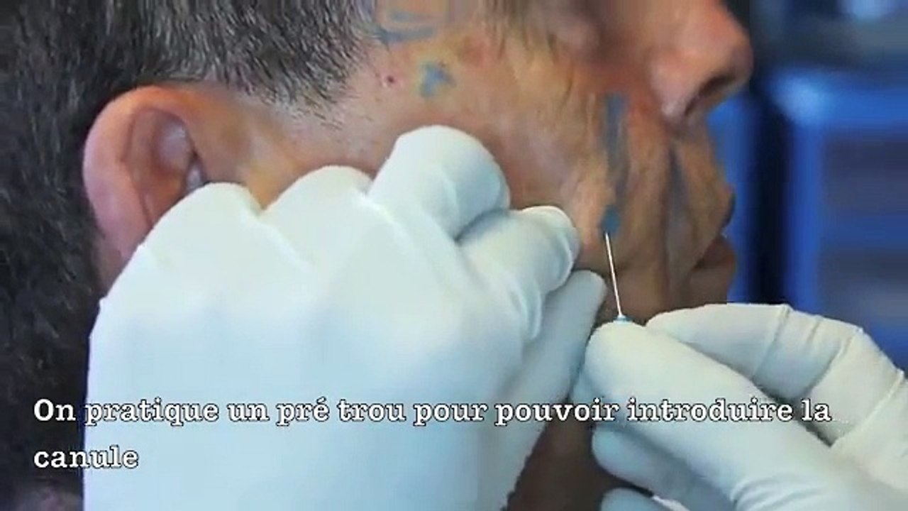 Médecine esthétique-Cas N° 8-Lifting Homme sans chirurgie-Rouen