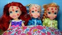 Elsa and Anna Toddlers Get Chicken Pox! PART TWO! - toddler anna and elsa