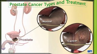 Prostate Cancer Symptoms, Types And Treatment