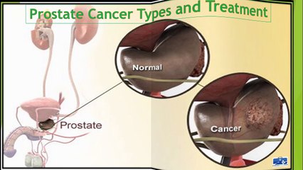 Prostate Cancer Symptoms, Types And Treatment
