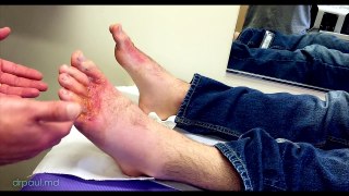HORRIBLE FOOT RASH: Wound Care | Dr. Paul