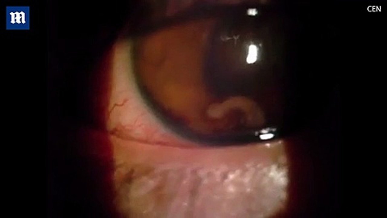 Rợn người đoạn clip sán trú ngụ và bò lúc nhúc trong mắt nam thanh niên gây mù vĩnh viễn