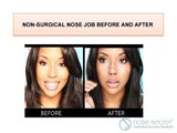 Non Surgical Nose Job Before and After