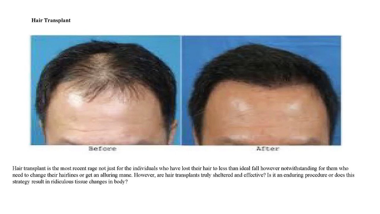 6_Amazing_Fact_About_Hair_Transplant