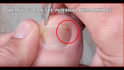 Ingrown Toenail Removal