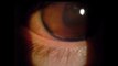 Worm digs holes in teen's eye for weeks