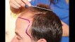 FUE Hair Transplant (3958 grafts in NW-Class lV-A), Dr. Juan Couto - FUEXPERT CLINIC