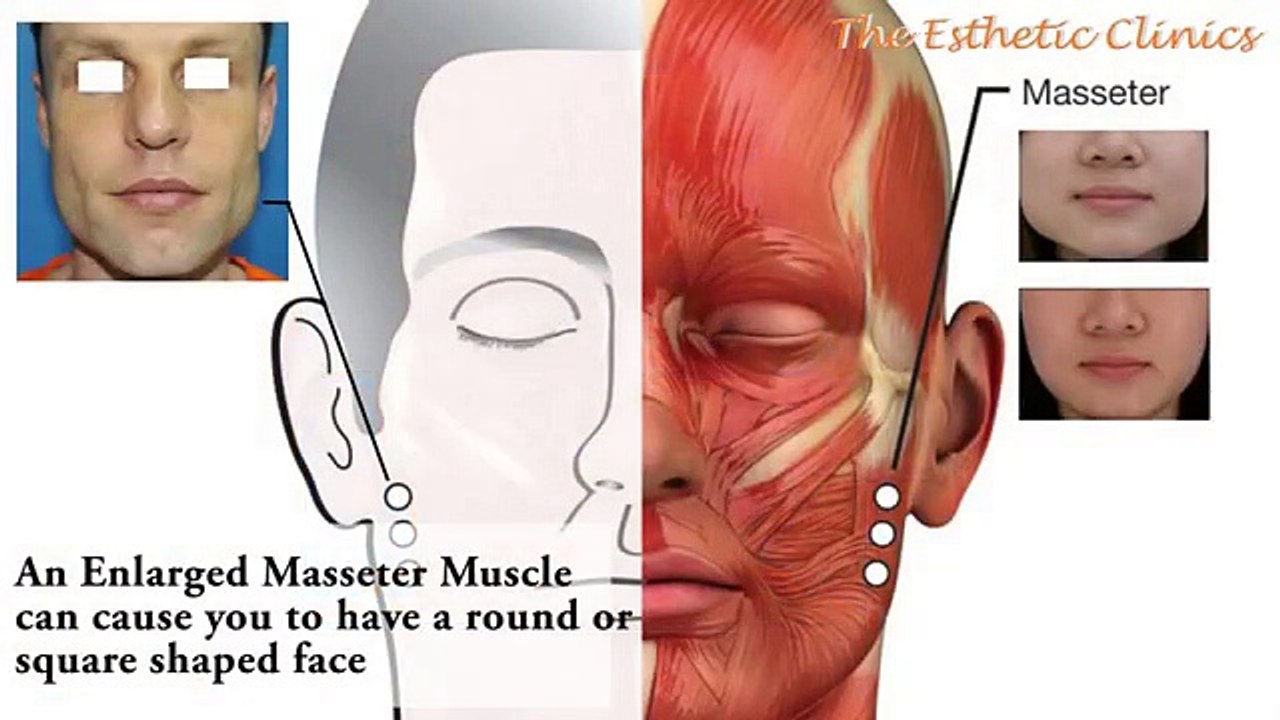 Change Shape of Face from Round to Oval using Botox Injections Mumbai, India - Dr. Debraj Shome