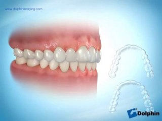 Şeffaf plaklarla ortodontik tedavi