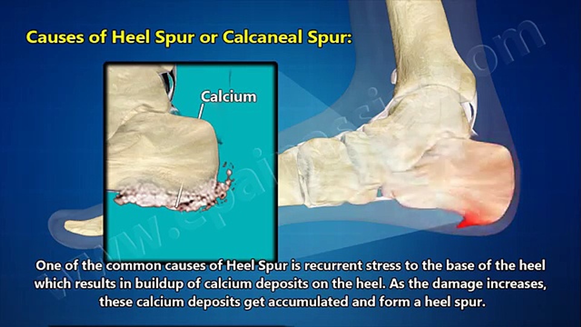retrocalcaneal heel spur