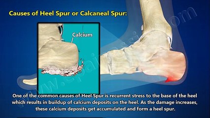 Heel Spur or Calcaneal Spur: Treatment, Causes, Symptoms, Prevention
