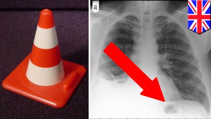 Man's lung cancer turns out to be Playmobil toy he inhaled as a kid