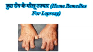 कुष्ठ रोग के घरेलू उपचार (Home Remedies For Leprosy)