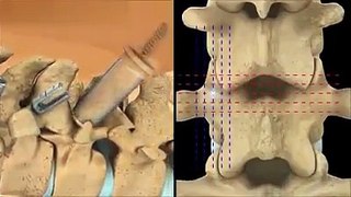 Spine Surgery India | хирургия позвоночника | جراحة العمود الفقري