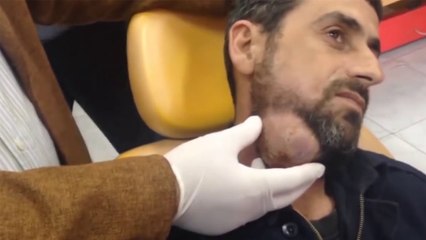 Cet homme a une énorme boule dans le cou, quand le chirurgien la perce, impossible de ne pas frémir