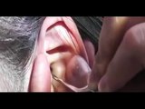 Chinese Ear Cleaning (181) DIY Ear Cleaning Relaxation and Stress Relief