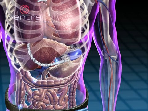 Medical device animations