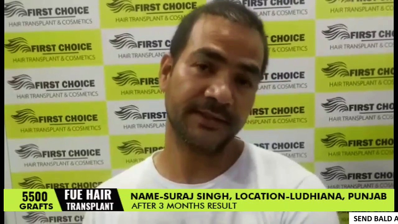 Hair Transplant in Ludhiana -Patient's Review about his results after 3 months of surgery