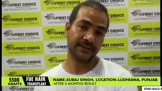 Hair Transplant in Ludhiana -Patient's Review about his results after 3 months of surgery