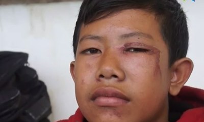 Puluhan Pengungsi Gunung Agung Diserang Serangga Tomcat