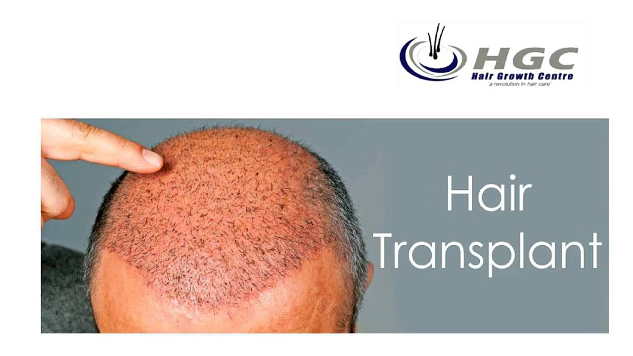 Must_Know_Fact_About_Hair_Loss