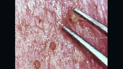 #22 Whitehead and BlackHead Removal/Extrion