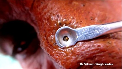 REMÈDE MIRACLE CONTRE LES POINTS NOIRS ET LES BOUTONS