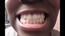 [WARNING] Teeth Whitening Baking Soda and Lemon - Bad Reaction - Before & After - The Mouth Episode