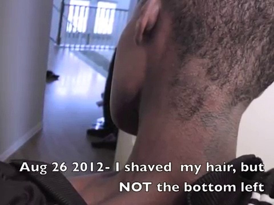 Alopecia Areata - My Hair Loss Journey (with pictures) new