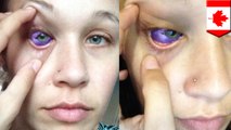 Model's eyeball tattoo goes dreadfully wrong