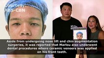 Rated K: Marlou's Surgery Transformation