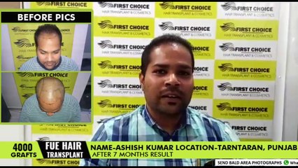 Patient's Reviews after 7 months of hair transplantation - 4000 grafts | Hair Transplant in Ludhiana